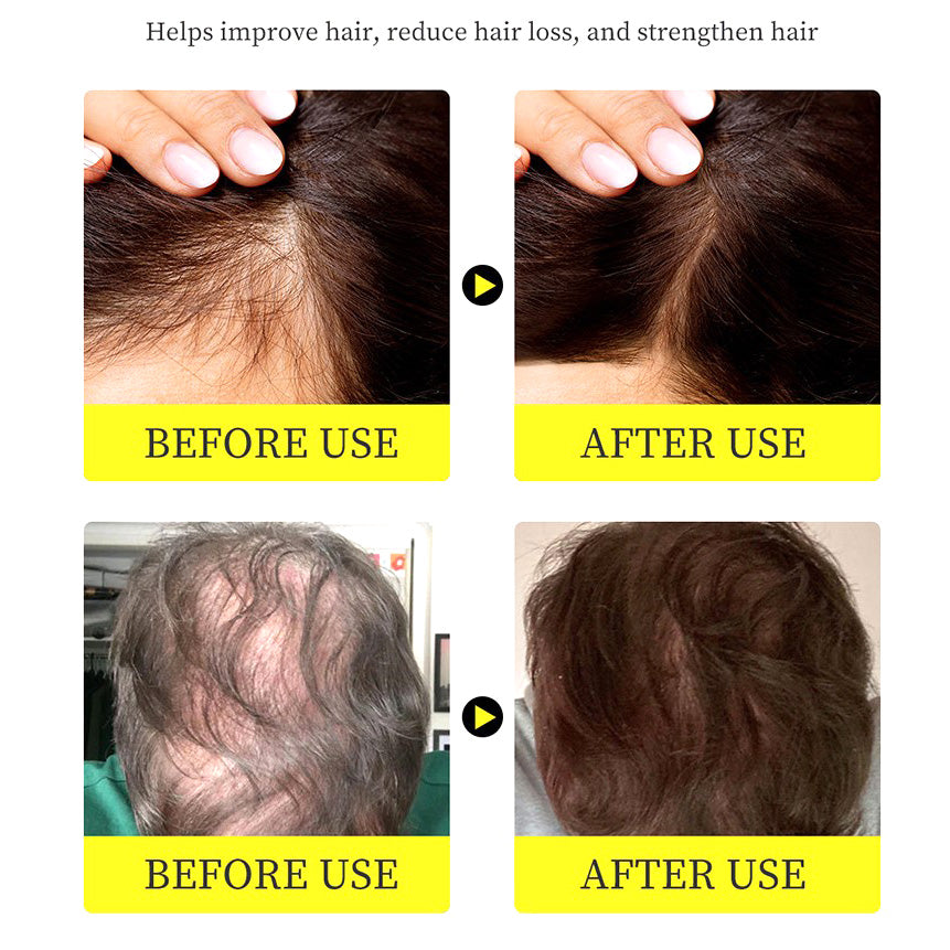 Aceite para Crecimiento del Cabello con Extractos Herbales Naturales（Mayoreo）